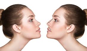 nose job philippine cosmetic surgery