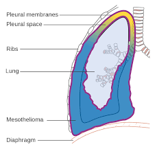The chance of dying of a malignancy (mesothelioma or lung cancer) versus a. File Diagram Of The Lung Showing Pleural Mesothelioma Cruk 458 Svg Wikimedia Commons