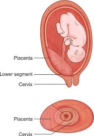 Mothers with placenta previa are also at higher risk of delivering prematurely, before 37 weeks of pregnancy. Jaypeedigital Ebook Reader