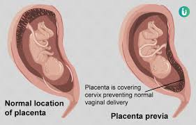 Placenta previa involves the placenta either partly or completely covering the opening of the uterus into the cervix, which is called the internal os. Placenta Previa Meaning Symptoms Diagnosis Treatment Complications