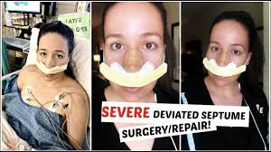 Surgery is indeed the most effective and promising treatment option for curing a deviated septum. Getting My Septo Rhinoplasty Surgery Repairing My Severe Deviated Septum Youtube