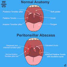 peritonsillar abscess management