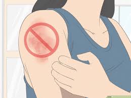 how to prevent heat rash 14 steps
