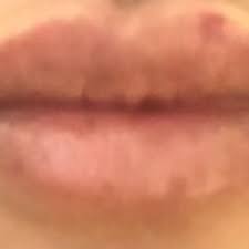 nerve irritation following lip