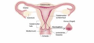 Zwischen dem inneren und äußeren muttermund liegt der zervixkanal, aus dem der sogenannte zervixschleim abgesondert wird. Was Wird Bei Einer Konisation Gemacht Apotheken Umschau
