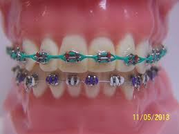 Fashionable Braces General Dentist Orthodontics Braces