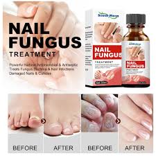 nail fungus treatment anti fungal nail