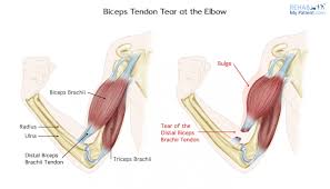 biceps tendon tear at the elbow rehab
