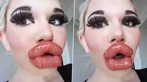 20th lip injection