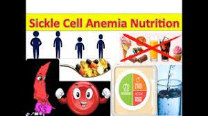 sickle cell anemia nutrition you