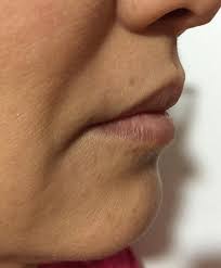 hyaluronic acid filler for the lips and