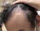 stop hairfall and hair thinning