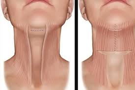 How to slim your facelifting saggy jowlsif you are interested in lifting saggy jowls and how to slim your face, my video on lifting sagging face gymnastics exercises for face tightening: How To Reduce Sagging Jowls Do This Bob Haircut For Fine Hair Short Hair Styles Pixie Short Hair Styles For Round Faces