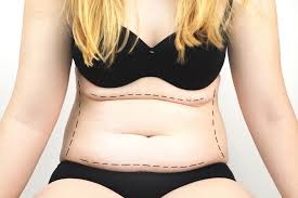 what is the best age for a tummy tuck