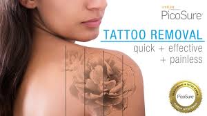 laser tattoo removal with the picosure