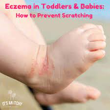 prevent scratching soothe itchy skin