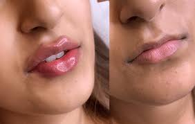 juvederm lip enhancements at charmelle