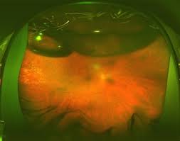 A patient with an acute retinal tear may experience the sudden onset of black spots or floaters in the affected eye. Floaters Retinal Tears And Retinal Detachments Visionaware