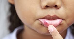 kids and canker sores a sore spot in