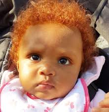 This kind of hair loss is called telogen effluvium. Beautiful Red Haired Baby Beautiful Black Babies Natural Red Hair Beautiful Babies