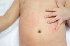 Baby rash on bumps wht to do to avoid rashes for babies? answered by dr. Rashes In Babies And Children What S My Child S Rash Netmums