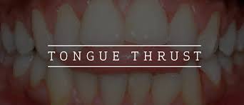 Will i need braces picture test, if you have an overbite do you need braces, do i need braces quiz buzzfeed, how to get braces when you don't need them, do i need braces quiz quotev, can you get braces even if your. How To Stop A Tongue Thrust Dougherty Orthodontics
