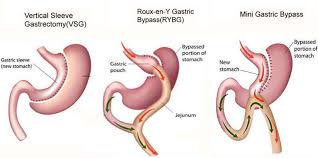 types of bariatric surgery weight