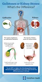 As for the coffee connection, i recommend that you continue to cut back. Fact Finding Gallstones Vs Kidney Stones Unitypoint Health