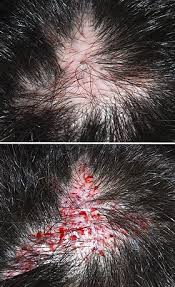 Baldness is almost exponentially worse the younger you are. Hair Transplantation Wikipedia