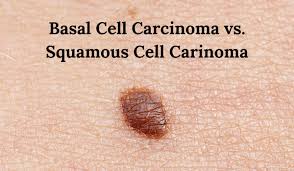 basal cell carcinoma vs squamous cell