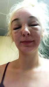 woman s face badly swollen after she