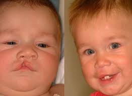 cleft lip and cleft palate surgery cost