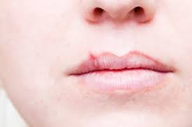 cold sores 9 things to know