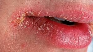 recur lip rashes cheilitis