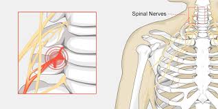 16 bones of the neck cervical vertebrae. Pinched Nerve The Complete Injury Guide Vive Health