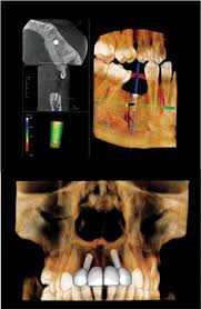 cone beam 3d imaging dental implants