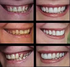Table of contents what are diy veneers? If Your Teeth Are Ugly But Healthy Is It A Bad Idea To Have Them Ground Down And Veneers Glued On Wouldn T This Make Them Less Healthy And Less Hygienic Due To