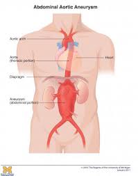 An aneurysm is an abnormal bulge or ballooning in the wall of a blood vessel. Abdominal Aortic Aneurysm Frankel Cardiovascular Center Michigan Medicine