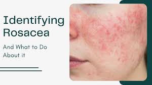 identifying rosacea and what to do