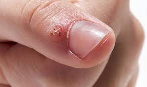 wart removal in singapore by moh