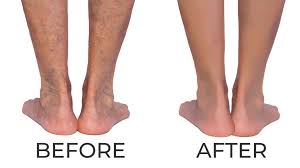 As it is not just a cosmetic issue, most insurance companies will fund varicose vein treatment. Texas Vein Experts I Treatment For Venous Disease Varicose Veins Painful Veins In Legs