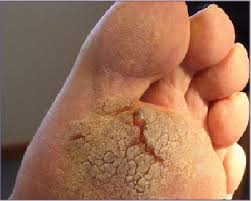 Plantar warts are different from most other warts. How To Treat Recalcitrant Plantar Warts Podiatry Today