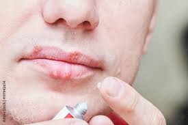 herpes simplex virus infection lips