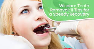 wisdom teeth removal 11 tips for a
