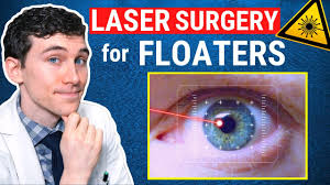 laser surgery for eye floaters