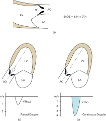 Cardiac Valves Thoracic Key