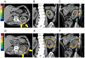proton beam therapy for renal pelvis