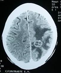 Brain Tumor Wikipedia