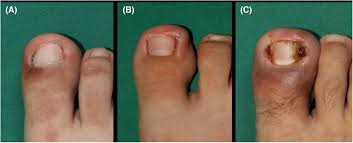 treating ingrown toenails