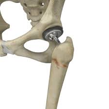 hip fracture surgery chicago partial